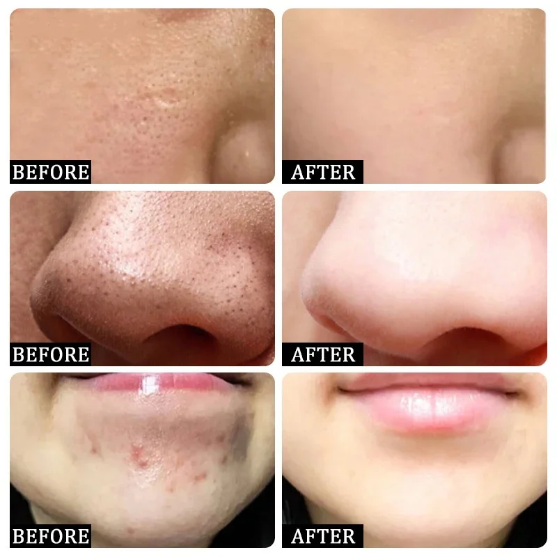 Salicylic Acid Pore Clearing C - Korean Skincare Routine recension och pris